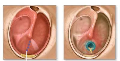 ear tube